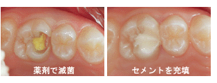 ３ＭＩＸ－ＭＰ療法、無痛治療について｜渡辺歯科