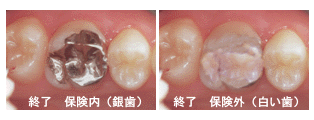 ３ＭＩＸ－ＭＰ療法、無痛治療について｜渡辺歯科